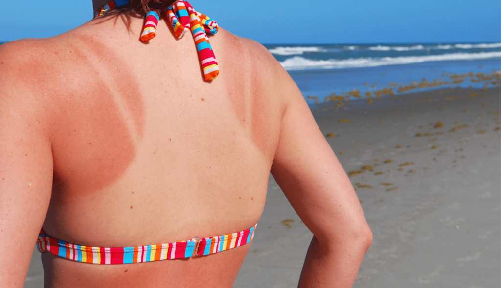 How to treat sunburn