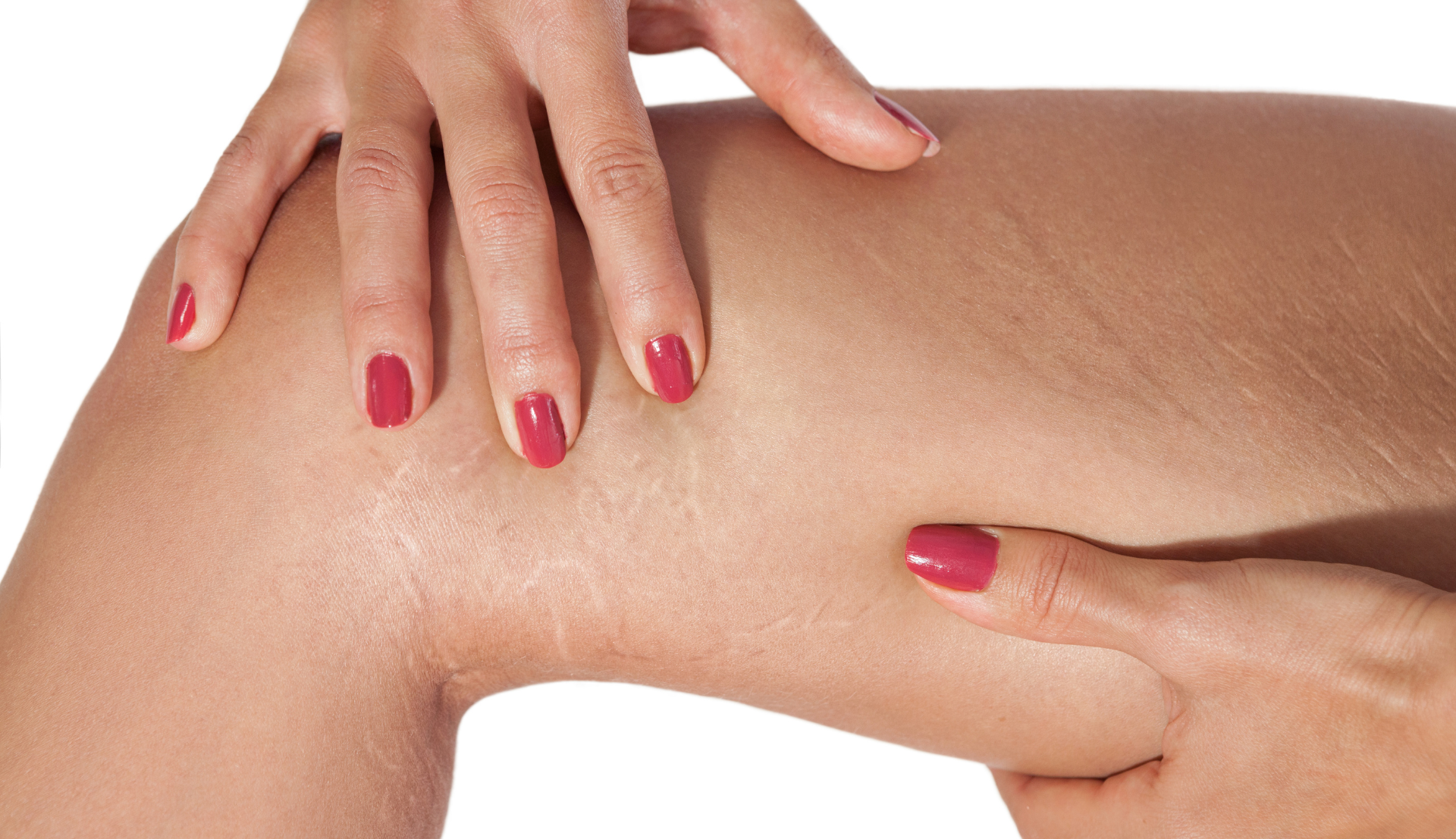 Is Mesotherapy Effective for <yoastmark class=