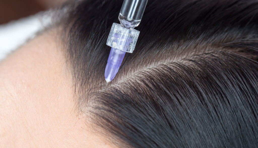 Tips for Choosing a Hair Mesotherapy Specialist
