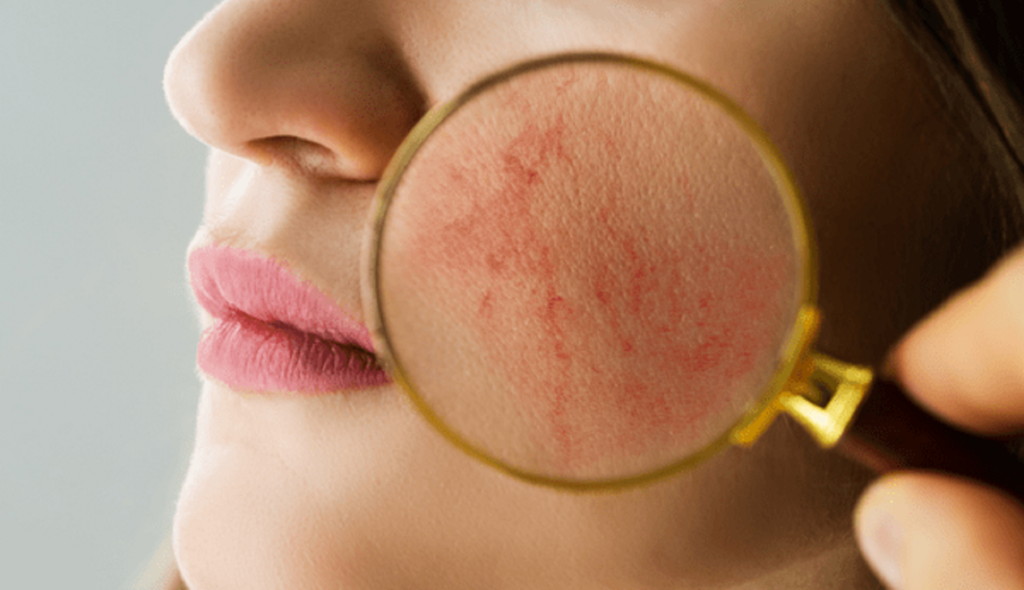 Unveiling the Mystery of Skin Red Spots: Prevention Tips for Radiant Skin