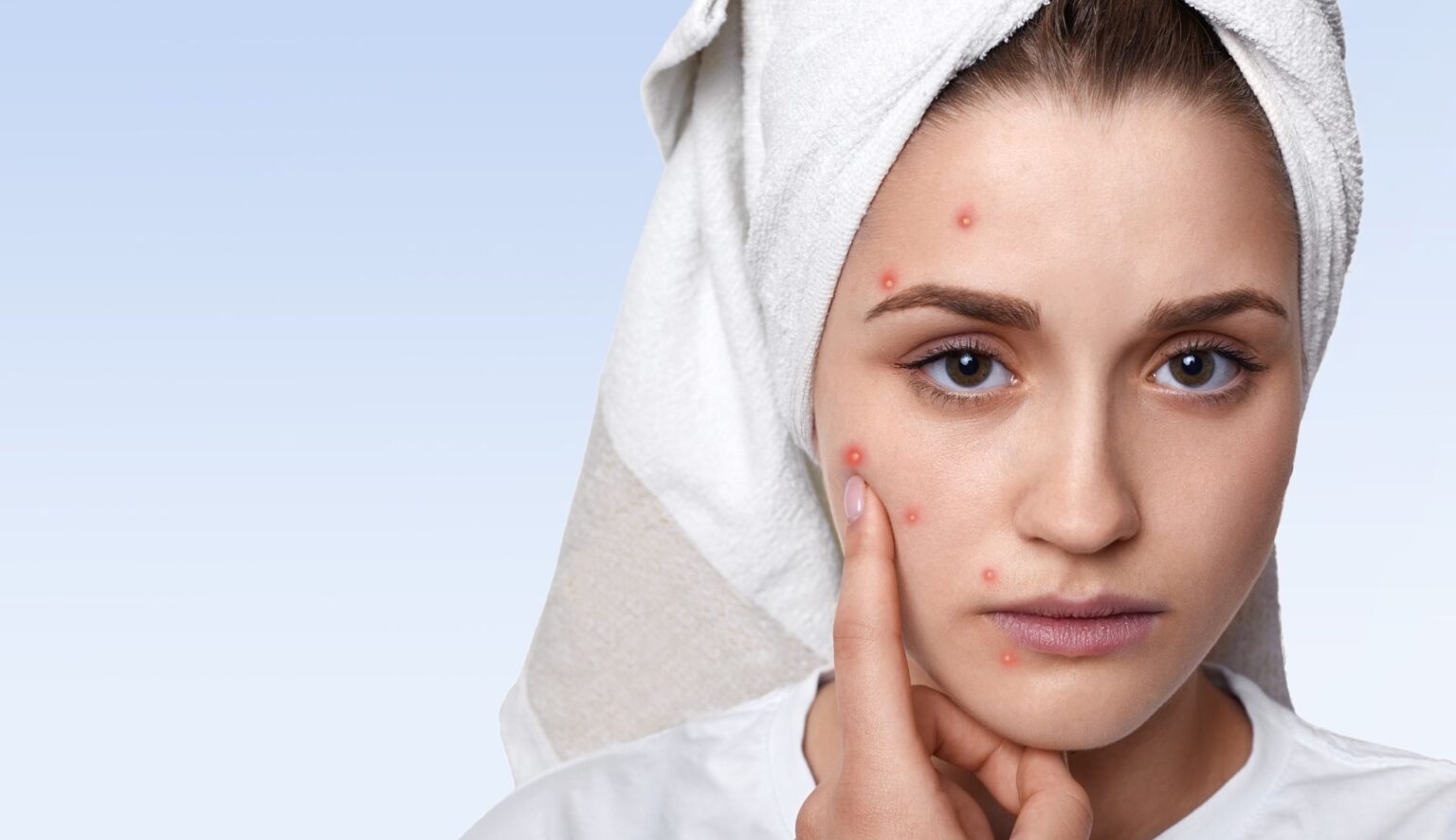 Mapping Out Acne: A Comprehensive Guide to Understanding and Treating 