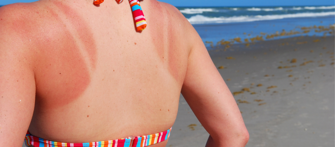 How to treat sunburn